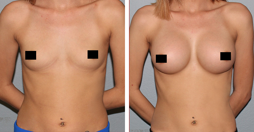in augmentation houston breast