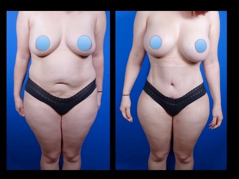 breast houston augmentation in