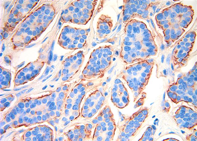 invasive carcinoma breast of micropapillary