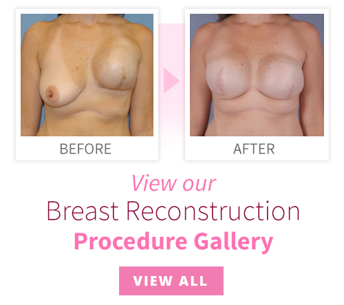 breast reconstruction images