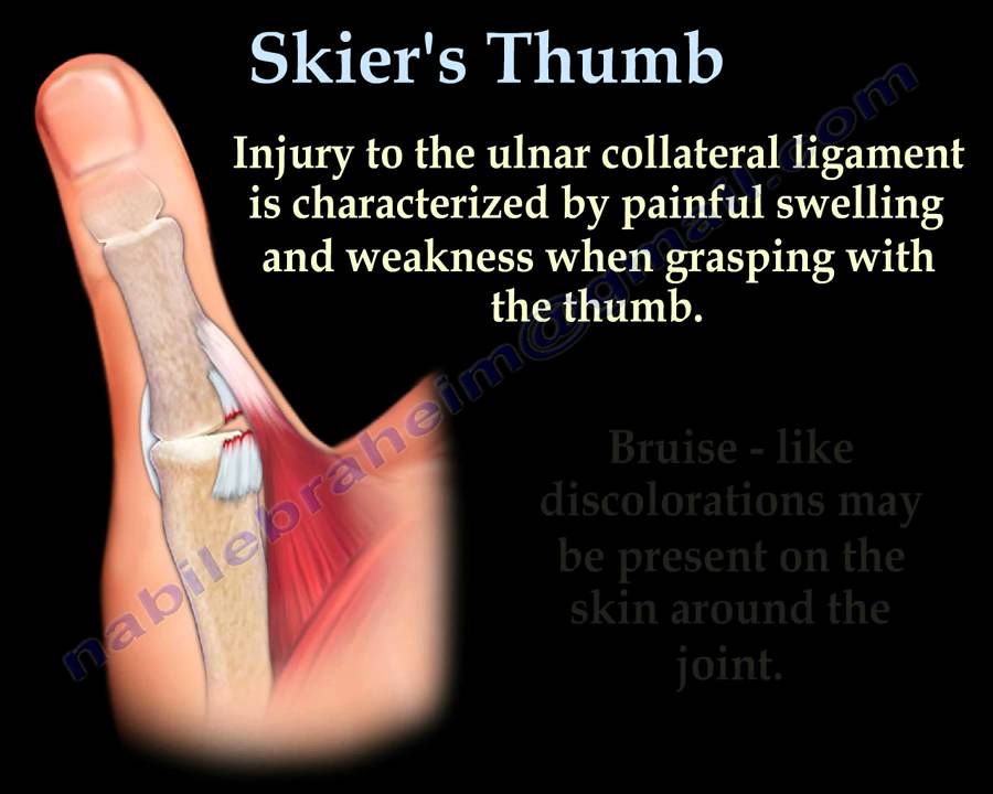 thumb ligament surgery