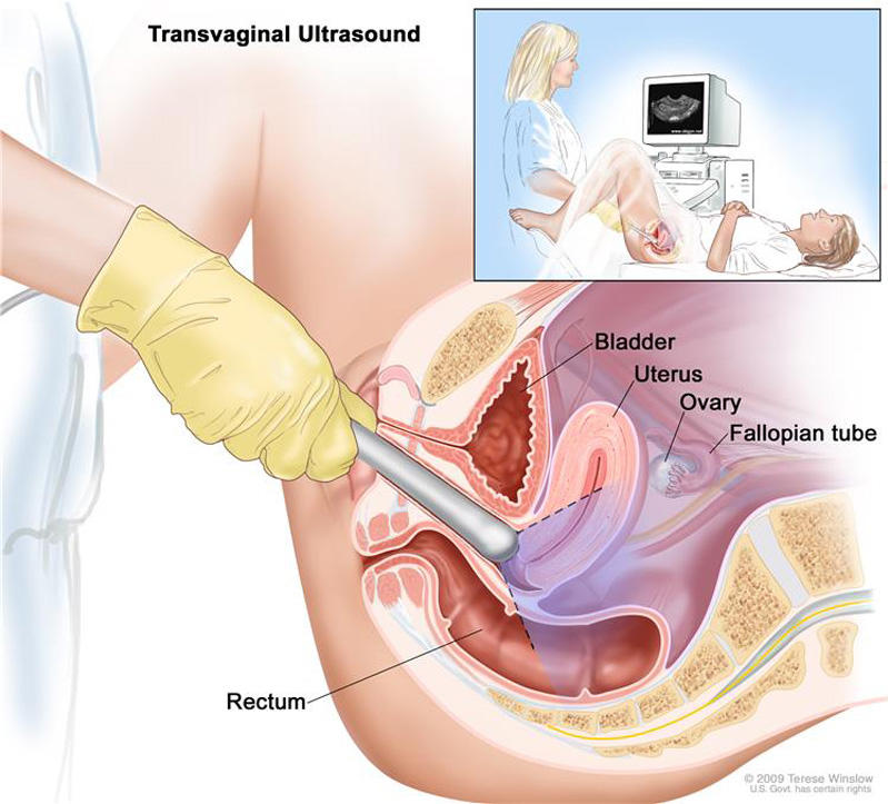 post menopause vaginal bleeding