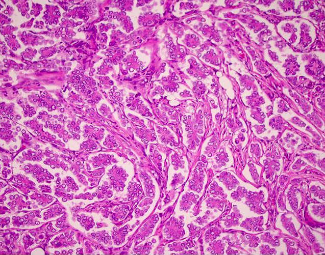 invasive carcinoma breast of micropapillary