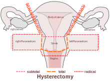 healing properly cuff vaginal hysterectomy not