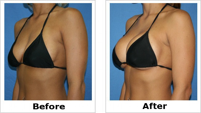in breast augmentation houston