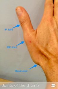surgery thumb ligament