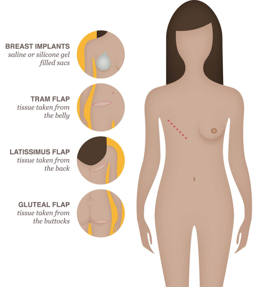 breast reconstruction images